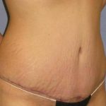 Tummy Tuck Before & After Patient #1087