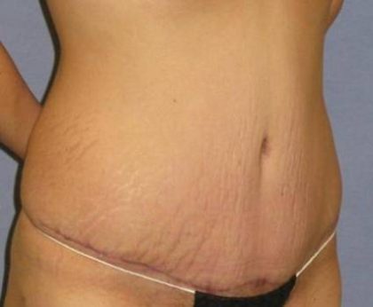 Tummy Tuck Before & After Patient #1087