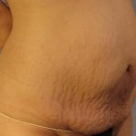 Tummy Tuck Before & After Patient #1087