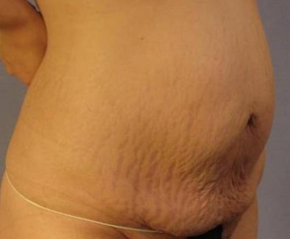 Tummy Tuck Before & After Patient #1087