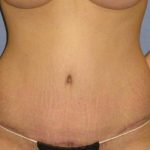 Tummy Tuck Before & After Patient #1087