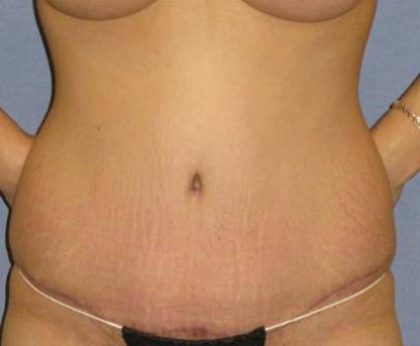Tummy Tuck Before & After Patient #1087