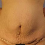 Tummy Tuck Before & After Patient #1087