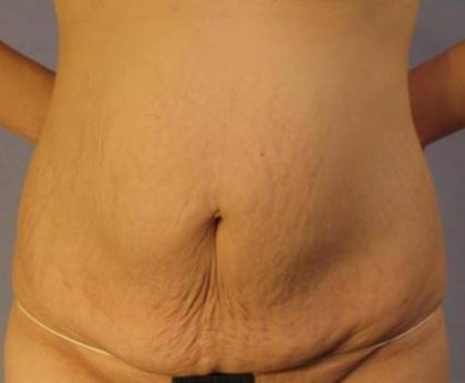 Tummy Tuck Before & After Patient #1087