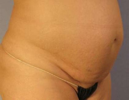 Tummy Tuck Before & After Patient #1099