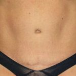 Tummy Tuck Before & After Patient #1099
