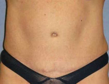 Tummy Tuck Before & After Patient #1099