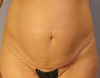 Tummy Tuck Before & After Patient #1099