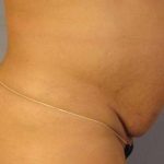 Tummy Tuck Before & After Patient #1099