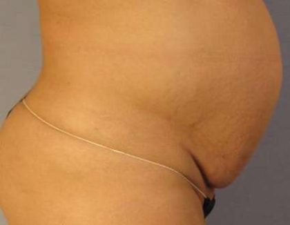 Tummy Tuck Before & After Patient #1099