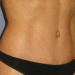 Tummy Tuck Before & After Patient #1106