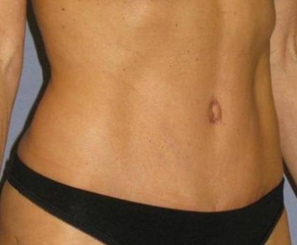 Tummy Tuck Before & After Patient #1106