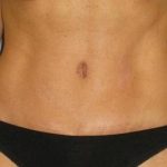 Tummy Tuck Before & After Patient #1106