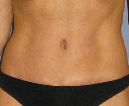 Tummy Tuck Before & After Patient #1106