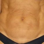 Tummy Tuck Before & After Patient #1106