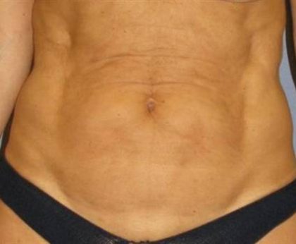 Tummy Tuck Before & After Patient #1106