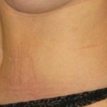 Tummy Tuck Before & After Patient #1113