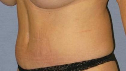Tummy Tuck Before & After Patient #1113