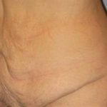 Tummy Tuck Before & After Patient #1113