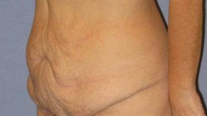 Tummy Tuck Before & After Patient #1113