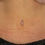 Tummy Tuck Before & After Patient #1113