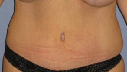 Tummy Tuck Before & After Patient #1113