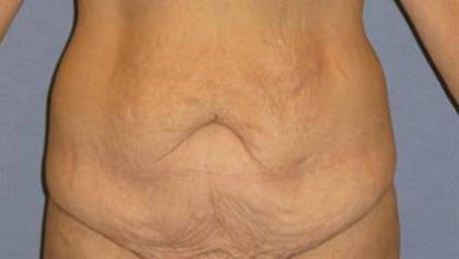 Tummy Tuck Before & After Patient #1113