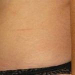 Tummy Tuck Before & After Patient #1113