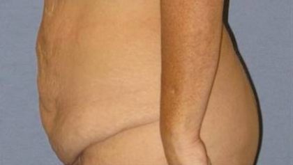 Tummy Tuck Before & After Patient #1113