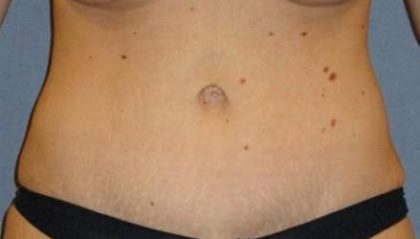 Tummy Tuck Before & After Patient #1120