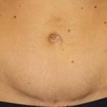 Tummy Tuck Before & After Patient #1120