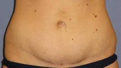 Tummy Tuck Before & After Patient #1120