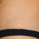 Tummy Tuck Before & After Patient #1120