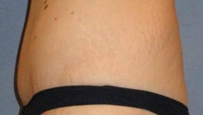 Tummy Tuck Before & After Patient #1120