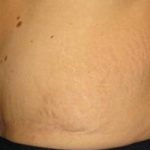 Tummy Tuck Before & After Patient #1120