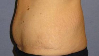 Tummy Tuck Before & After Patient #1120