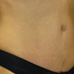 Tummy Tuck Before & After Patient #1125