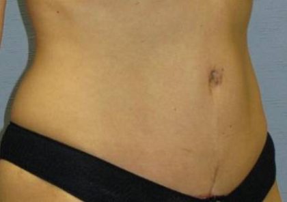 Tummy Tuck Before & After Patient #1125