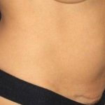 Tummy Tuck Before & After Patient #1125