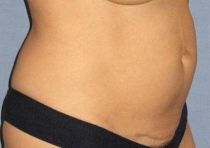 Tummy Tuck Before & After Patient #1125