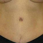 Tummy Tuck Before & After Patient #1125