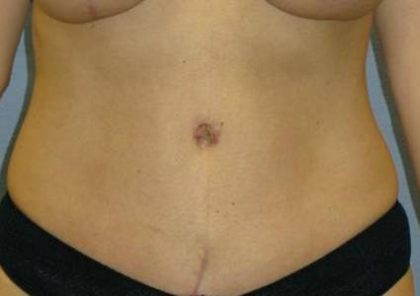 Tummy Tuck Before & After Patient #1125