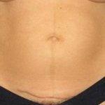 Tummy Tuck Before & After Patient #1125