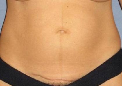 Tummy Tuck Before & After Patient #1125