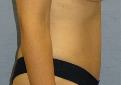 Tummy Tuck Before & After Patient #1125