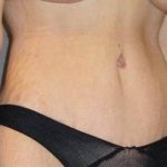 Tummy Tuck Before & After Patient #1139