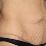 Tummy Tuck Before & After Patient #1139