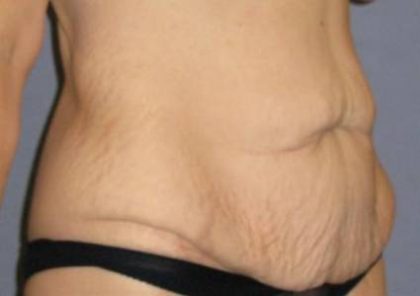 Tummy Tuck Before & After Patient #1139