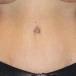 Tummy Tuck Before & After Patient #1139