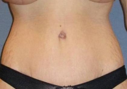 Tummy Tuck Before & After Patient #1139